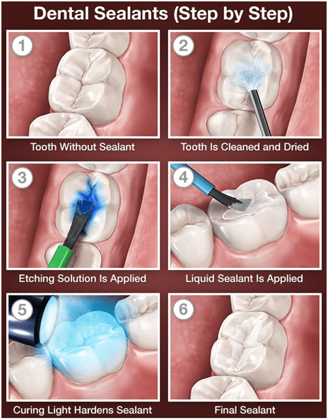 dental sealants ballantyne