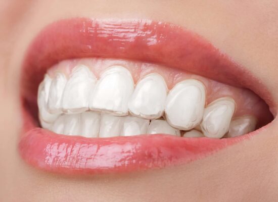 Invisalign Ballantyne Charlotte | Invisalign Crowded Teeth in NC