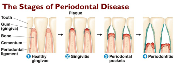 Periodontal Treatments and Procedures | Periodontal Services Charlotte ...