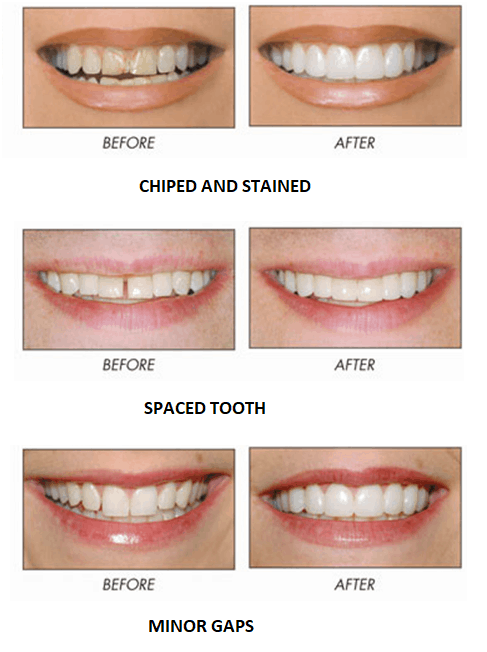 Dental Bonding Ballantyne Nc | Composite Bonding Front Teeth Charlotte NC