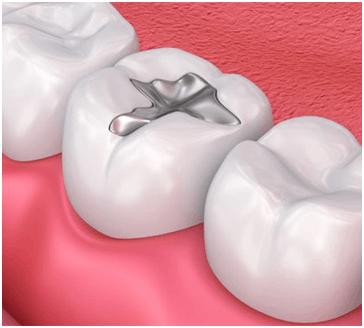 dental filling ballantyne charlotte nc