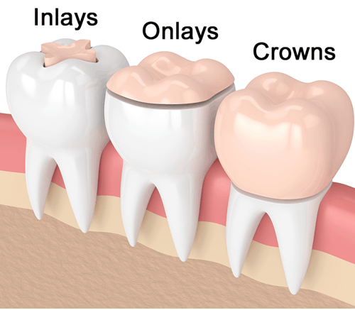 inlay onlay crowns ballantyne nc