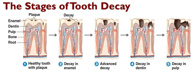 stages of tooth decay charlotte