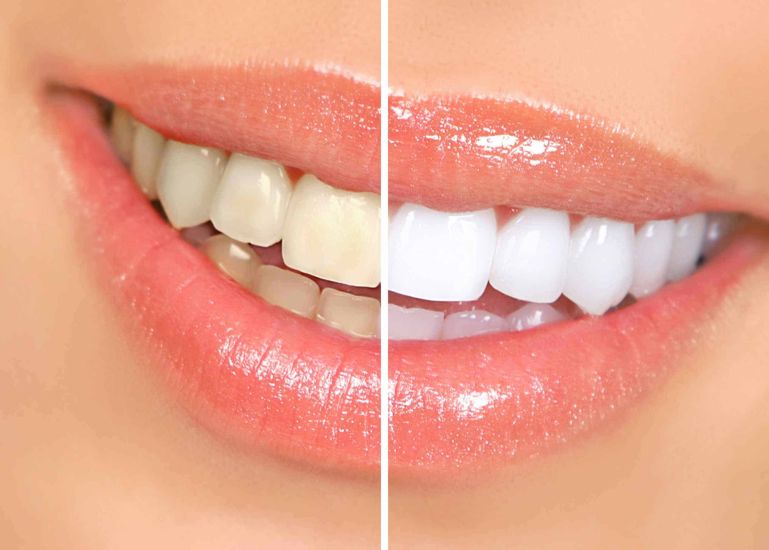 teeth whitening ballantyne nc