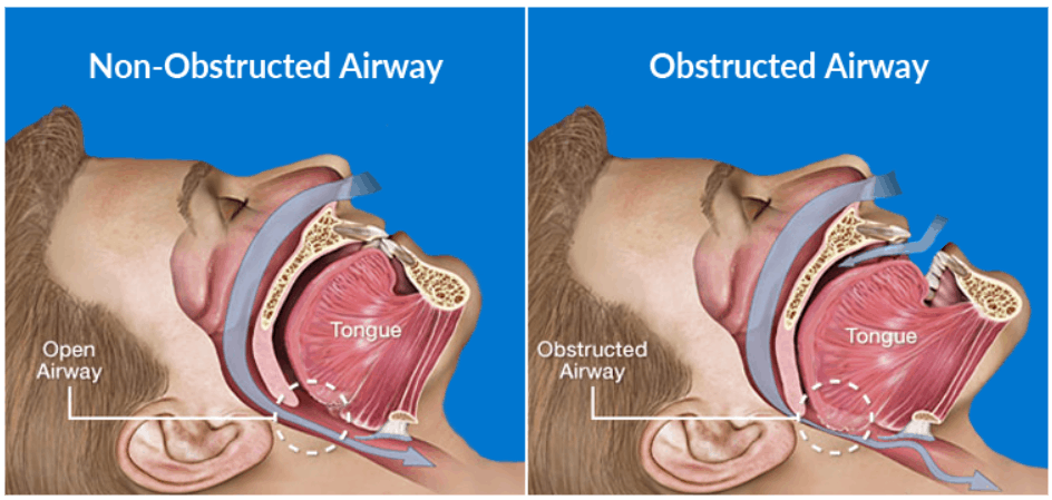 obstructed and non obstructed airway