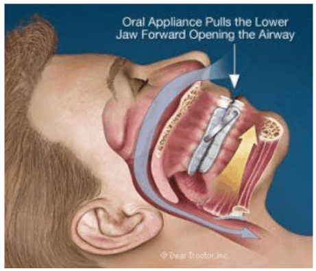 sleep apnea device