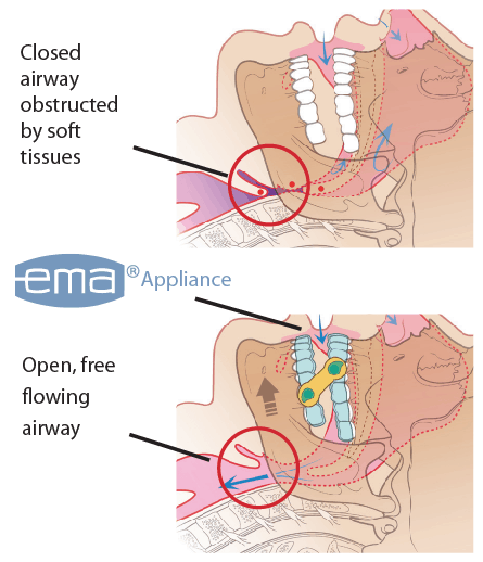 close and open airway
