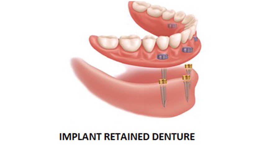 Implant Retained Denture