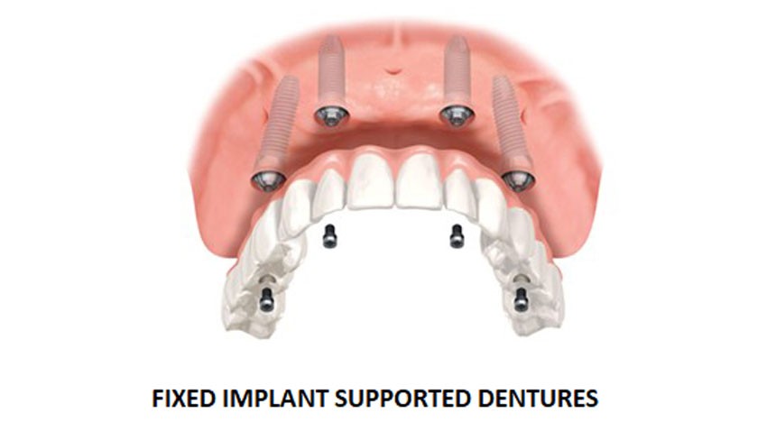 Fixed Impalnt Supported Dentures