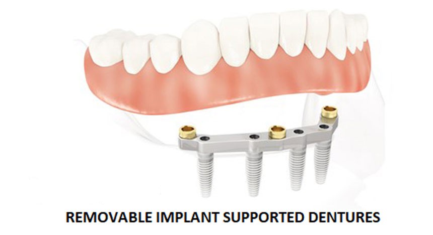 Removable Impalnt Supported Dentures