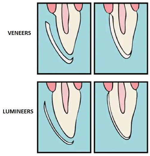 Dental Lumineers