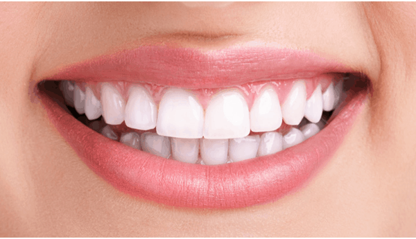 Teeth Whitening Treatment at Apollo Dental | Professional Teeth Whitening Charlotte