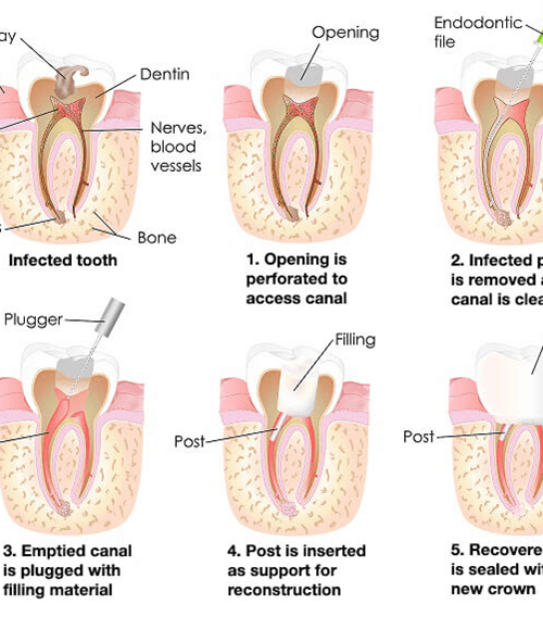 Root Canal Treatment | Root Canals Charlotte