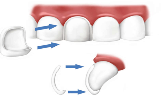 Dental Veneers